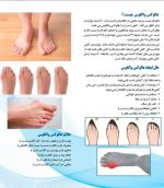 هالوکس والگوس تنظیمی - تصویر 2